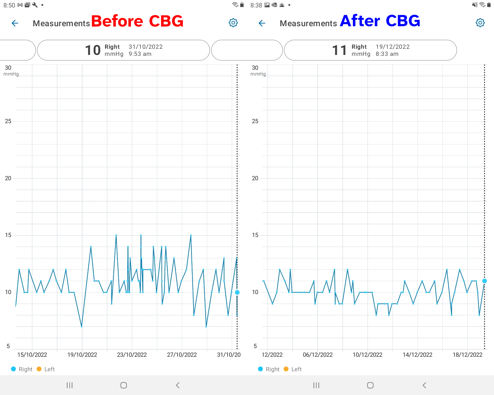 IOP Before and After Cannabigerol (CBG)